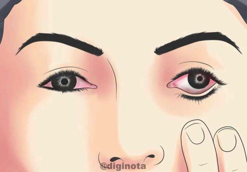 Todo sobre el Chikungunya y cómo recuperarse 84