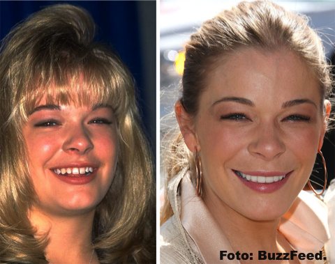 La sonrisa perfecta no siempre fue parte de estos artistas gracias a la ORTODONCIA INSTANTÁNEA 72