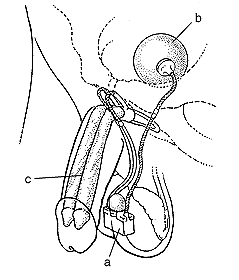 Ilustración de un implante inflador