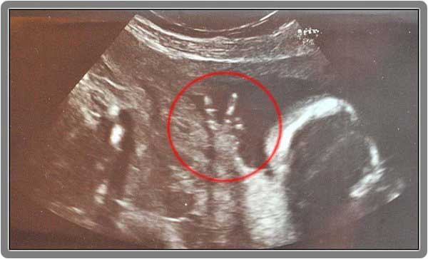 Owen, el bebé de la "V" de la victoria nace sano 1