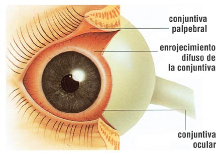 conjuntivitis