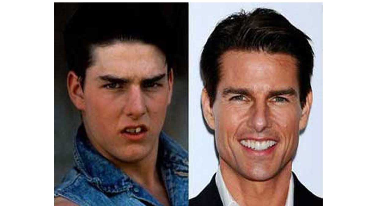 El antes y después de algunos famosos que se arreglaron los dientes fotos 1