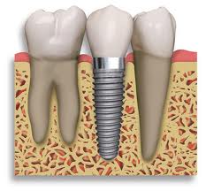 Todo lo que debes saber sobre los implantes dentales 49