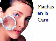 melasma o manchas en la cara