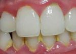calculo-dental-o-sarro