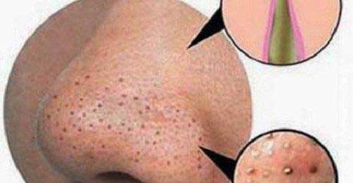 Cómo eliminar los puntos negros de forma casera