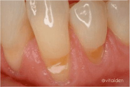 manchas dientes