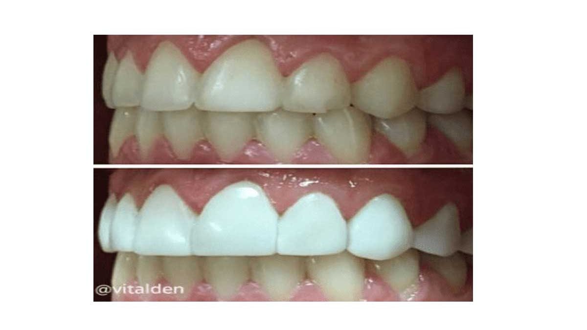 CARILLAS DENTALES, TRATAMIENTO VERSÁTIL E INNOVADOR 19