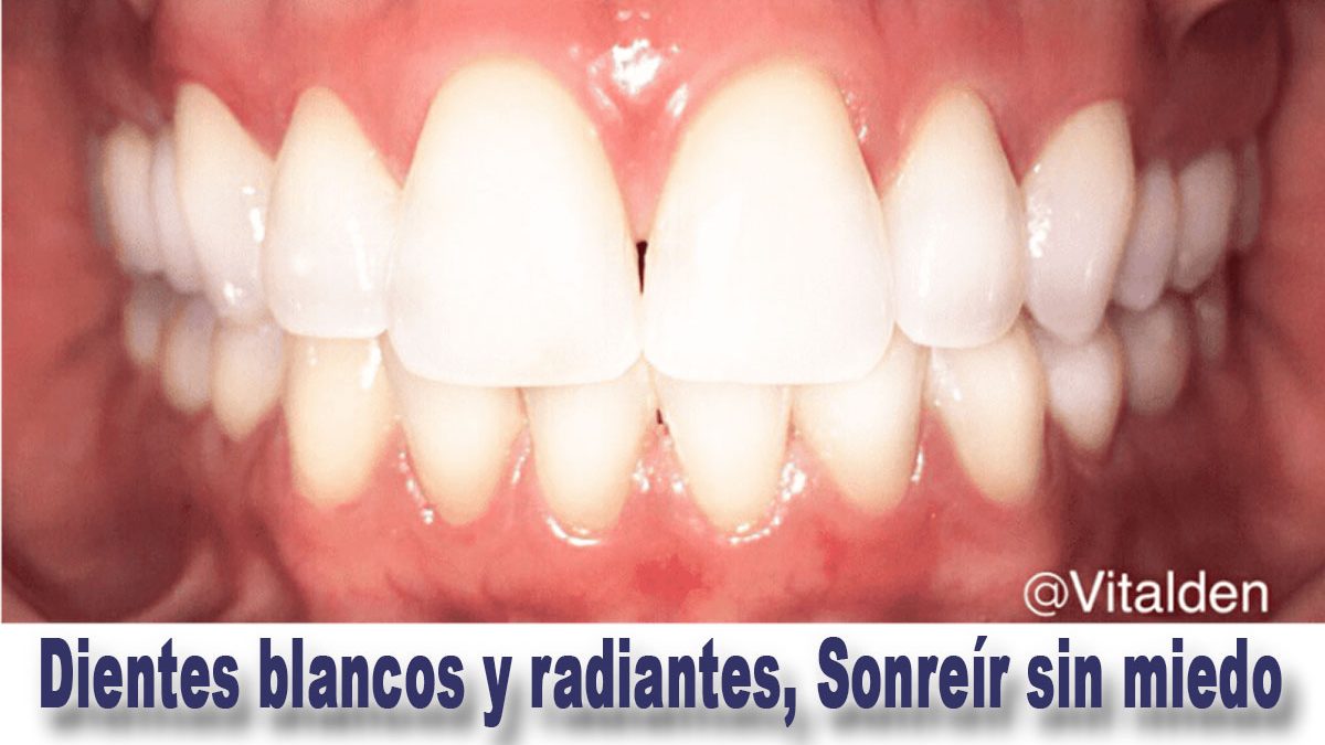 Dientes blancos y radiantes, Sonreír sin miedo 23