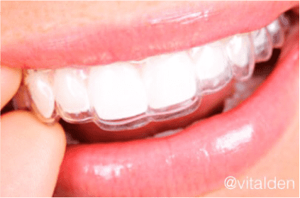 ferula dental