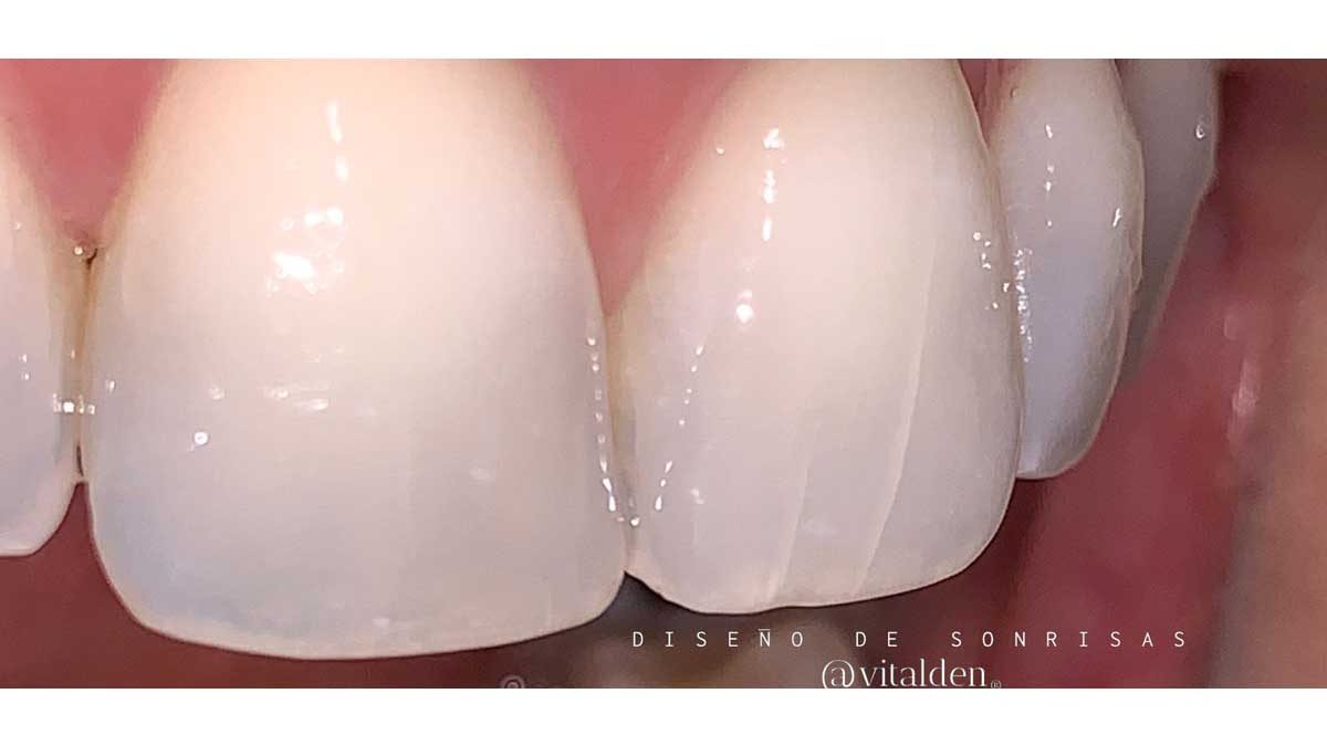 ¿Has notado grietas en tus dientes? 13