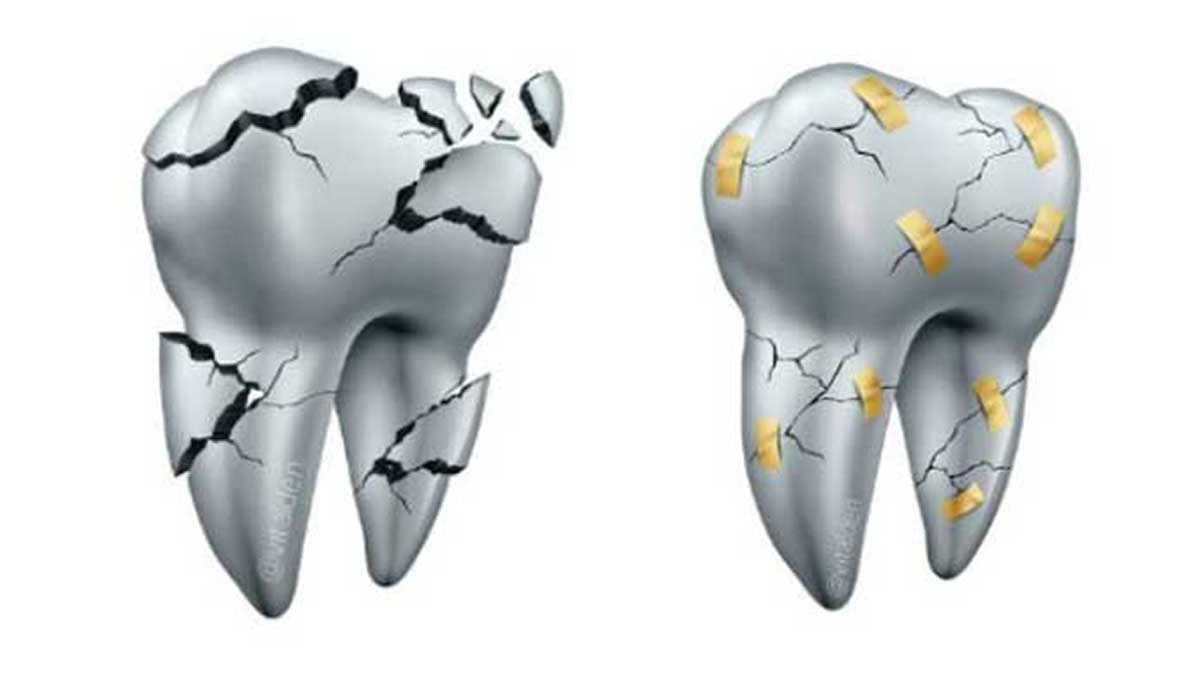 Carillas de Cerámica se pueden reparar en boca en vez de Reemplazarlas. 9