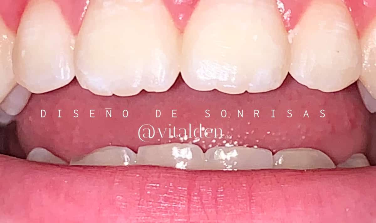 dental estetica infantil