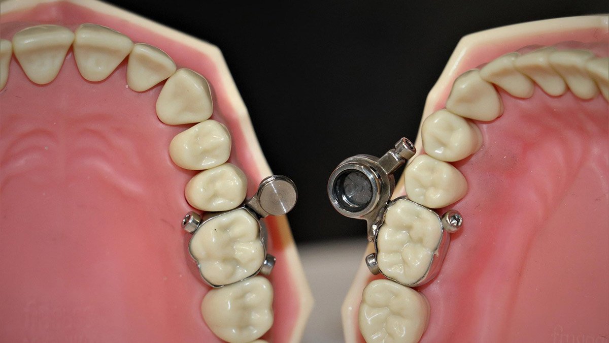 DentalSlim: es un dispositivo intraoral instalado por un profesional para la perdida de peso.
