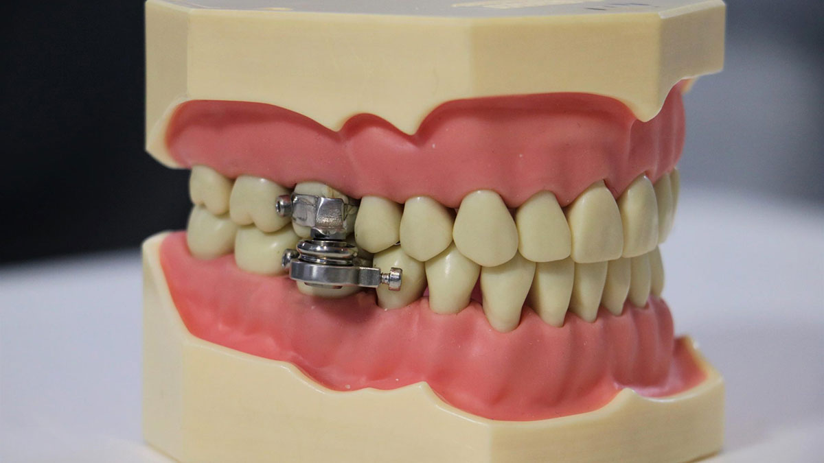 DentalSlim: desarrollan el primer dispositivo de pérdida de peso